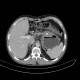 Stomach tumour: CT - Computed tomography